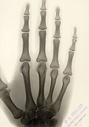 Radiographie - Main